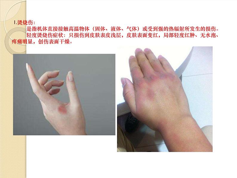 五至六年级体育与健康3.2 轻度损伤的自我处理(课件) 人教版(15张PPT)第3页