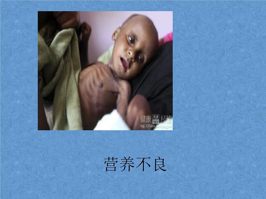 20秋人教版小學三四年級體育與健康《營養(yǎng)不良與肥胖》ppt課件1第2頁