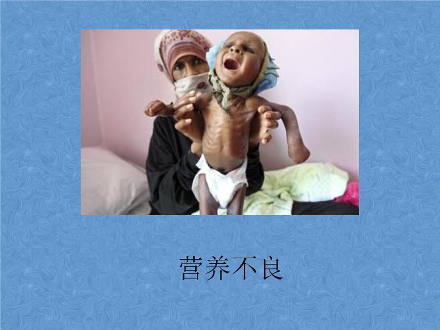 20秋人教版小學三四年級體育與健康《營養(yǎng)不良與肥胖》ppt課件1第3頁