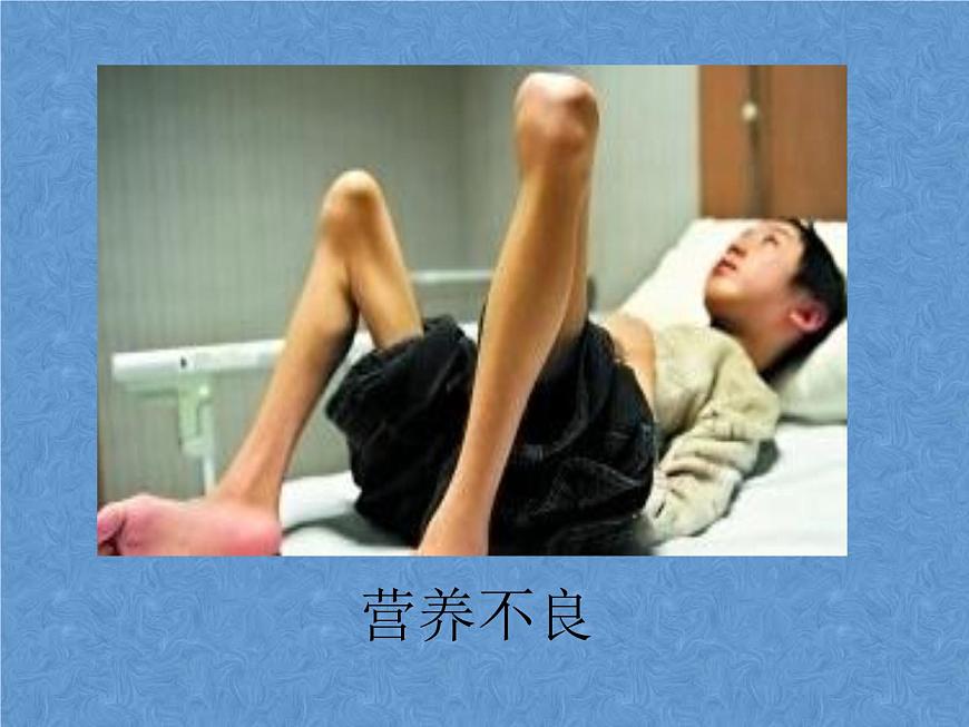 20秋人教版小學三四年級體育與健康《營養(yǎng)不良與肥胖》ppt課件1第4頁