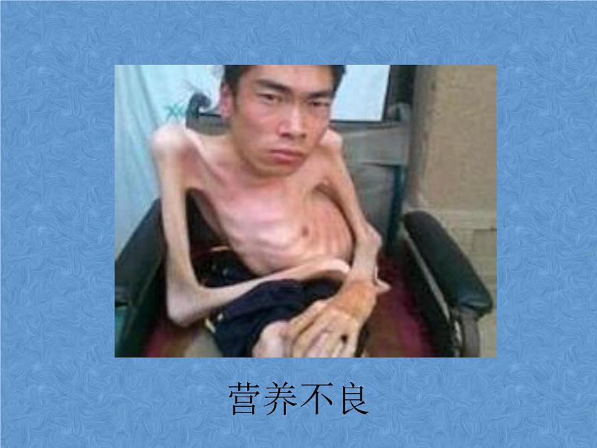 20秋人教版小學三四年級體育與健康《營養(yǎng)不良與肥胖》ppt課件1第5頁