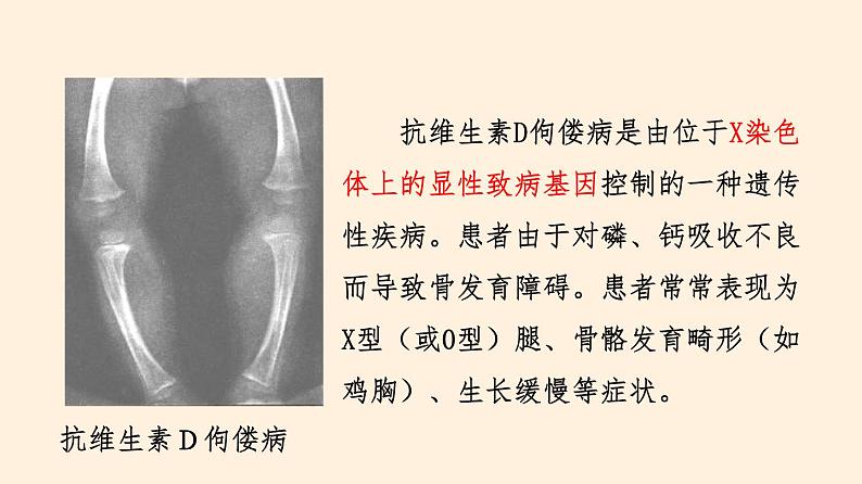 20.6 遗传病和人类健康 课件 初中生物北师大版 八年级上册(2021年)第6页
