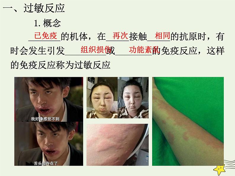 新人教版高中生物选择性必修1第4章免疫调节第3节免疫失调课件05