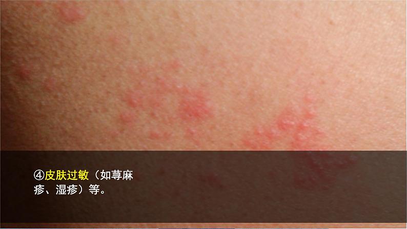 4.3 免疫失调第2页