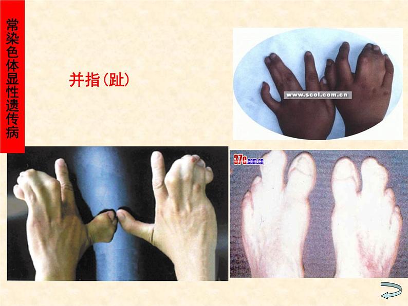 高中人教版生物必修2教学课件:5.3 人类遗传病2 Word版含答案08