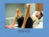 人教版小学三四年级体育与健康《营养不良与肥胖》ppt课件1