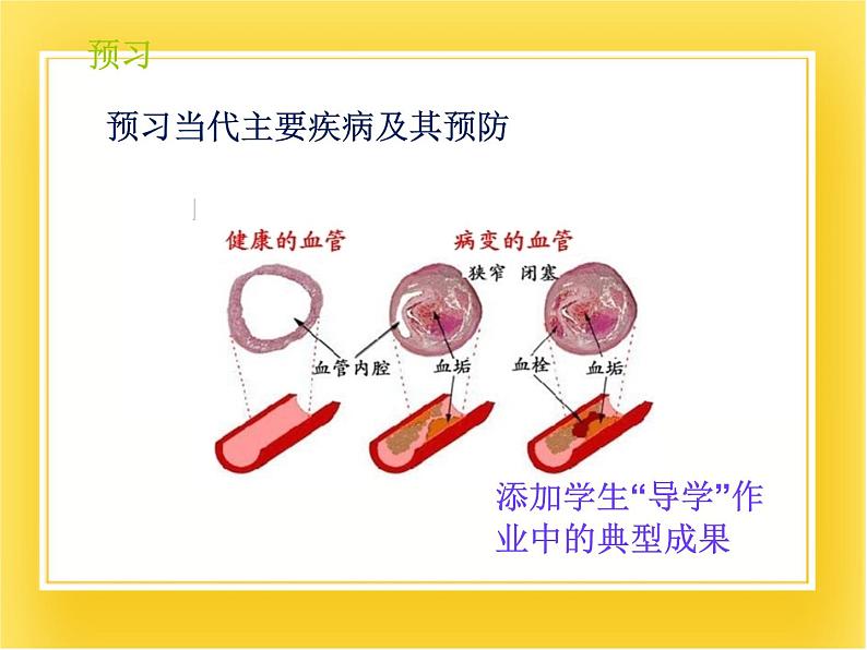 第十五章第三节《当代主要疾病及其预防》课件02