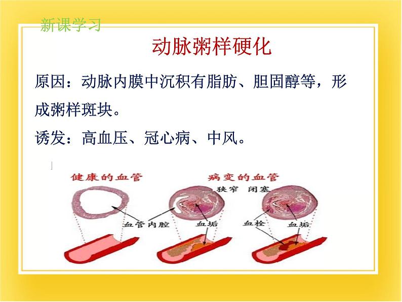 第十五章第三节《当代主要疾病及其预防》课件07