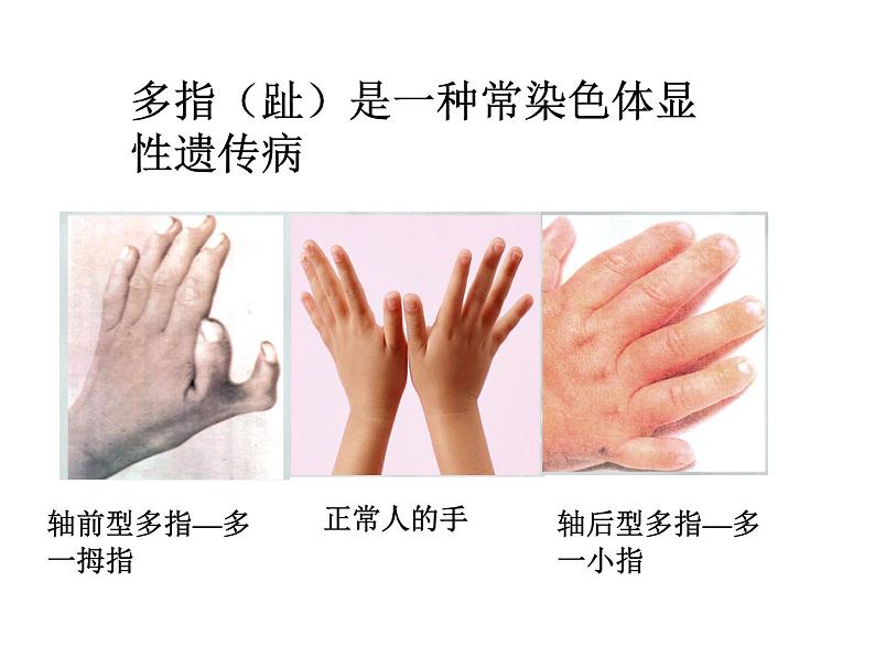 北师大版八年级上册生物  20.6 遗传病和人类健康 课件第3页