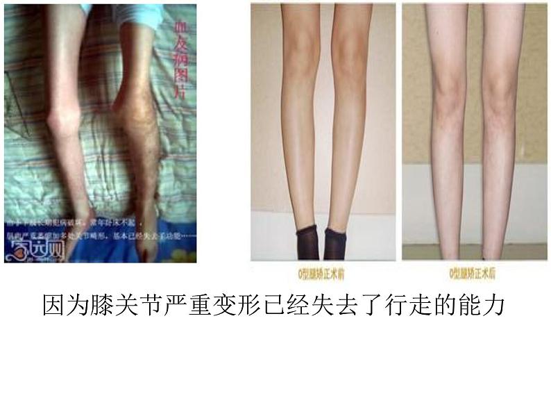 北师大版八年级上册生物  20.6 遗传病和人类健康 课件第4页