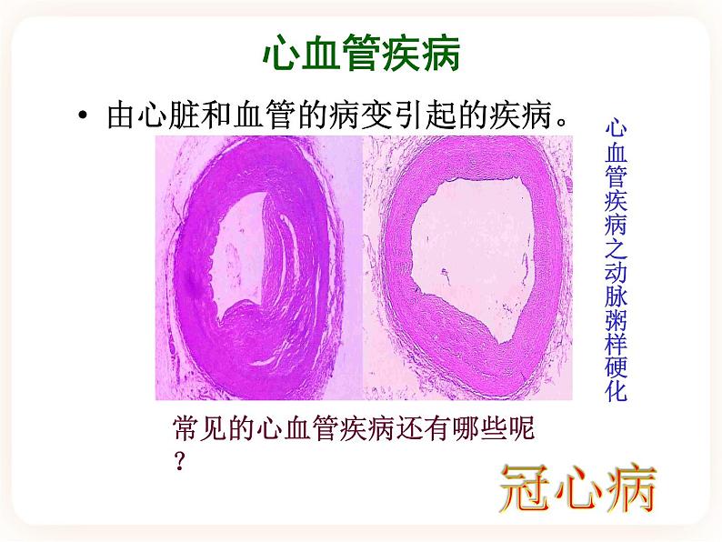 25.2威胁健康的主要疾病 课件03