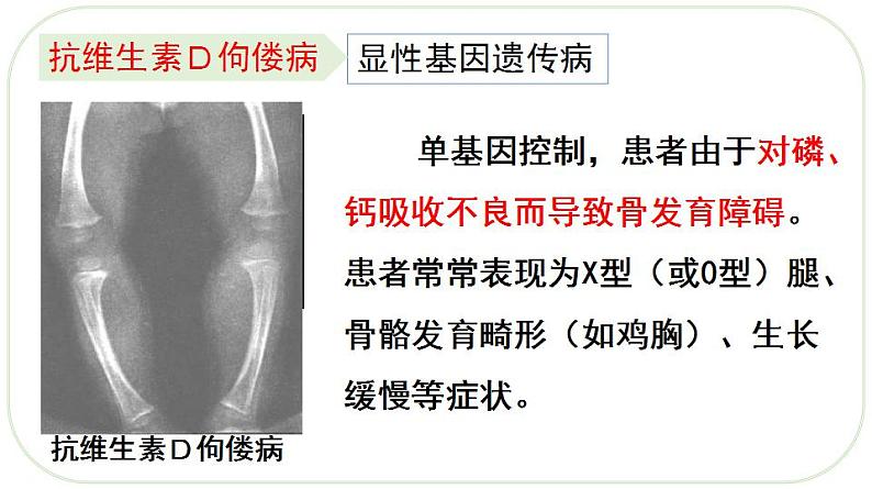 20.6 遗传病和人类健康课件八年级生物上册（北师大版）07