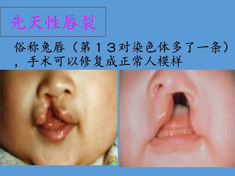 苏教版生物八年级下册 第二十二章 第四节 遗传病和优生优育(8)-课件第5页