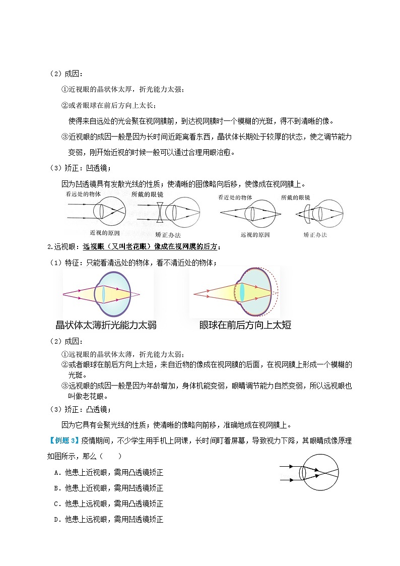 人教版八年级物理上册 5.4眼睛和眼镜（讲义）学生版+解析第3页