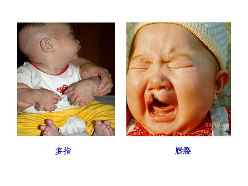 高中生物同步课件：第5章 第3节  人类遗传病（人教版必修2）04