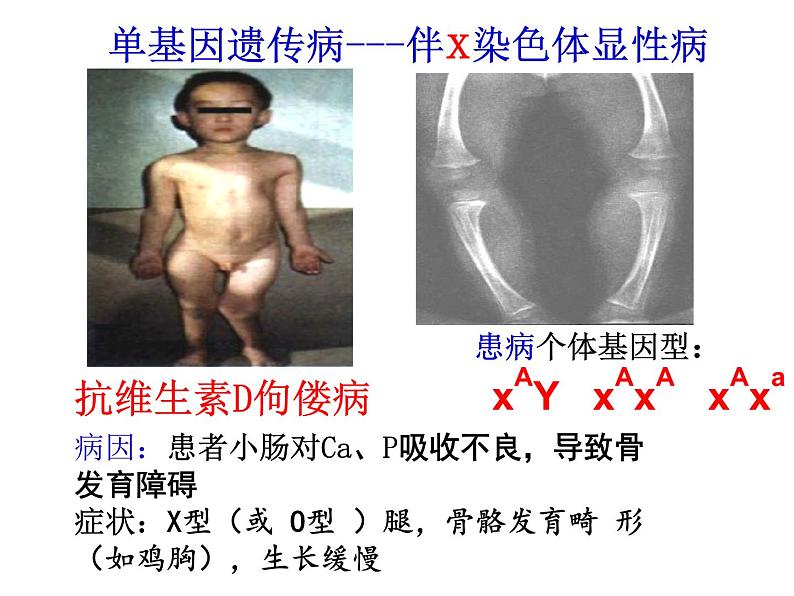 高中生物必修二 5.3 人类遗传病课件PPT07