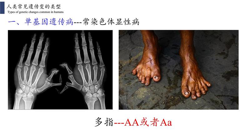 5.3  人类遗传病课件PPT07