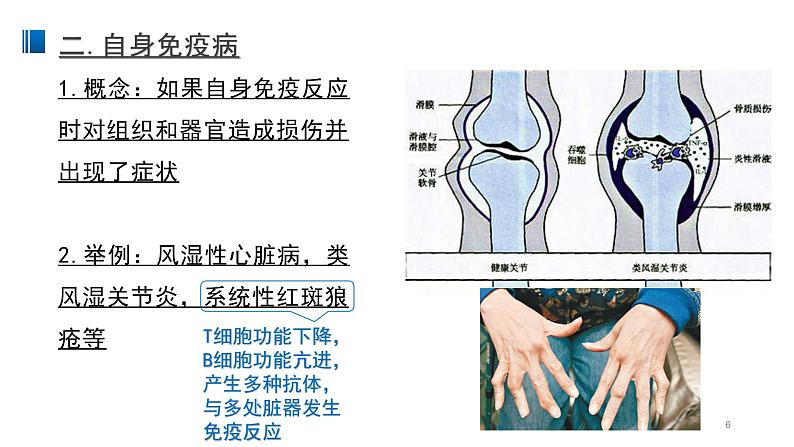 4.3 免疫失调 课件 【新教材】人教版（2019）高中生物选择性必修一06