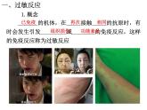 2021-2022学年高中生物新人教版选择性必修1  第4章 第3节 免疫失调 课件（37张）