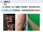 4.3免疫失调课件2021-2022学年高二上学期生物人教版选择性必修1