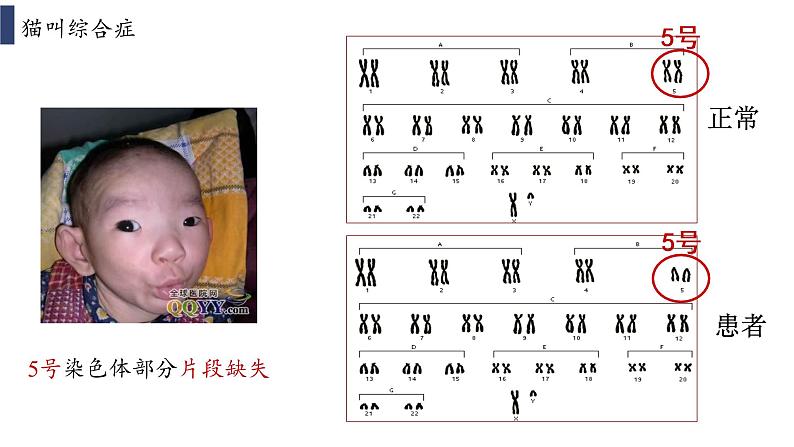 4.3.1 《染色体畸变可能引起性状改变》课件+教案05