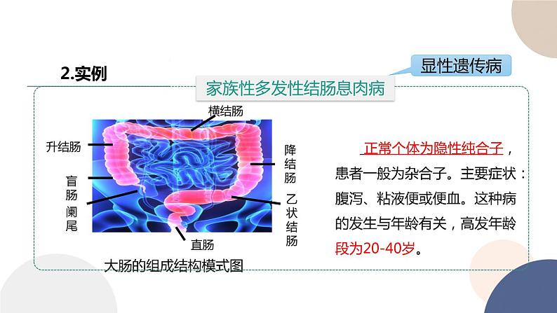 第三章 第三节 关注人类遗传病（课件PPT）第5页