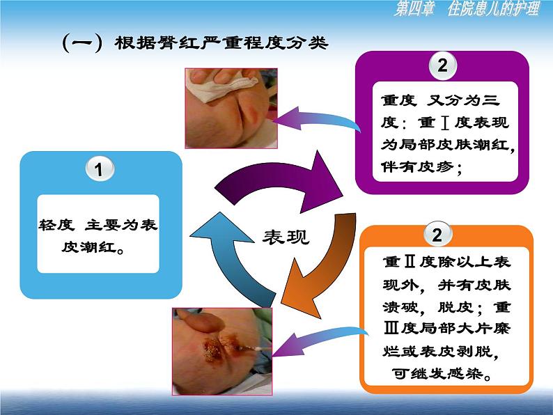 《儿科护理》第4章 第4节 儿科常用护理技术(3.4)实践五 臀红的护理+约束法 课件07