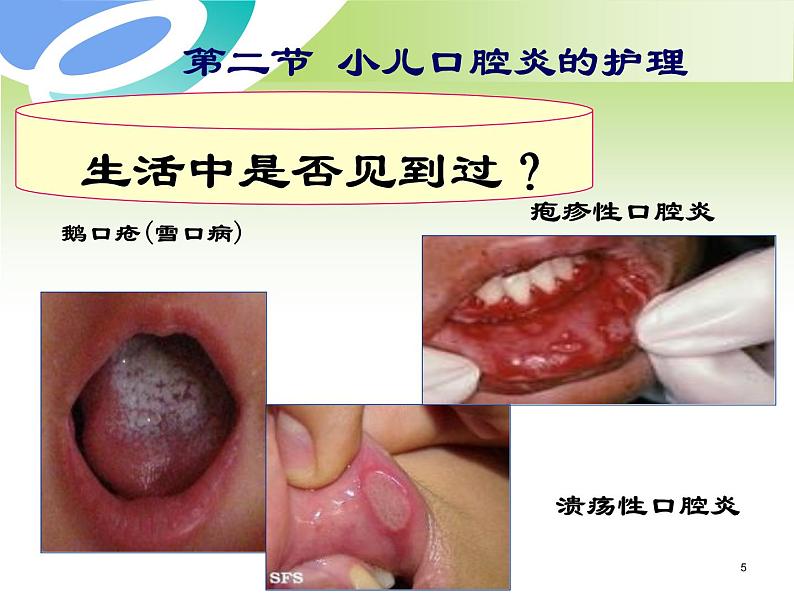 第9章-第2节 小儿口腔炎的护理 课件05