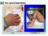 第五章  学前儿童生理疾病的预防与护理课件PPT